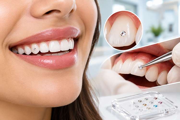 Dental jewellery application at Dr. Zahers Aesthetic Dental Center in Al Jurf, Ajman